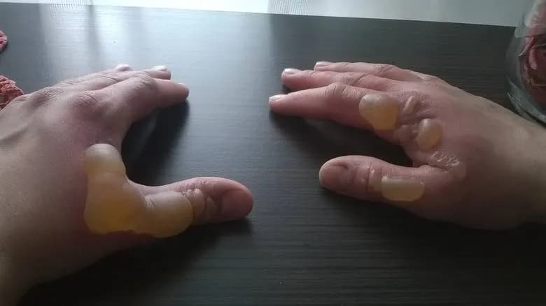 Oparzenie gazem LPG co robić: skuteczne metody pomocy i bezpieczeństwa